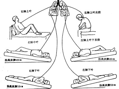 预防肺脓肿要注意哪些事项